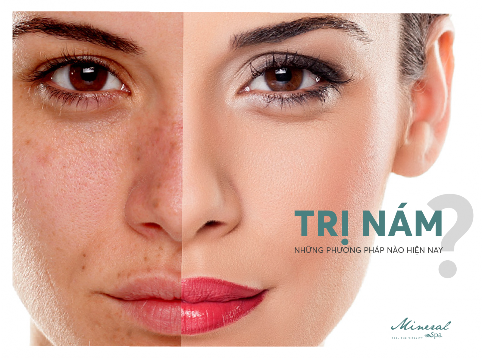 Trị nám Công nghệ Mesotherapy